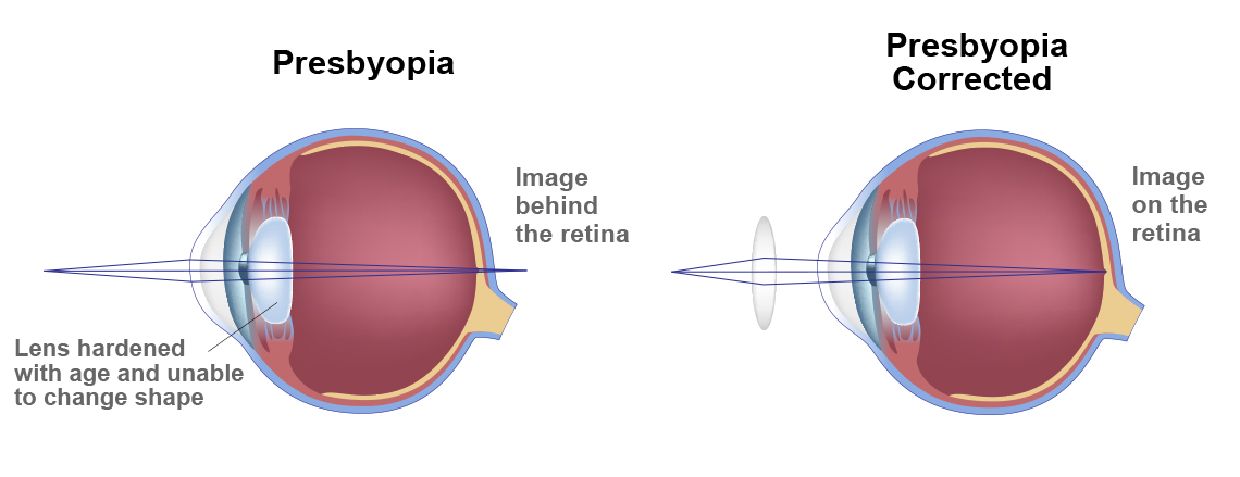 Presbyopia-3.jpg